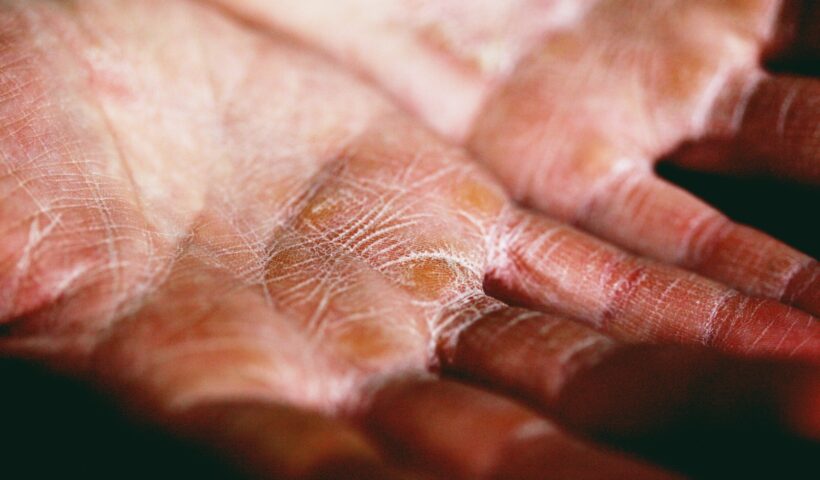 Eczéma : pourquoi cette maladie a la peau dure