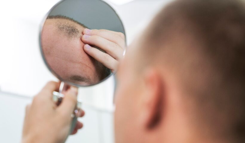 L'évolution de la Greffe de Cheveux : Les Technologies Innovantes Redéfinissant la Restauration Capillaire